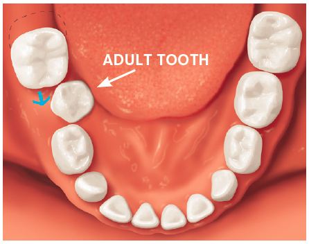 adult teeth crowded