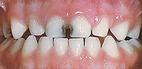 Moderate to severe decay baby teeth