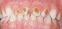 Moderate to severe decay baby teeth
