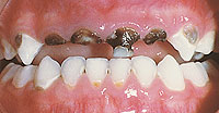 severe decay baby teeth