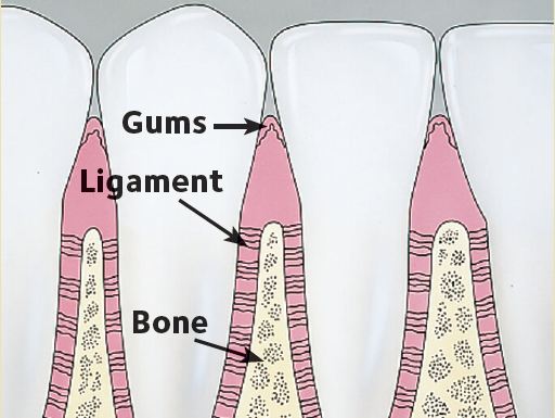 Gingivitis