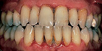 Periodontitis