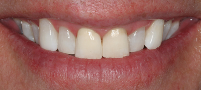 After whitening