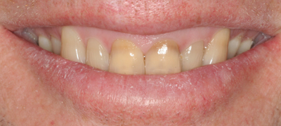 Before whitening