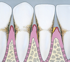 Unhealthy gums