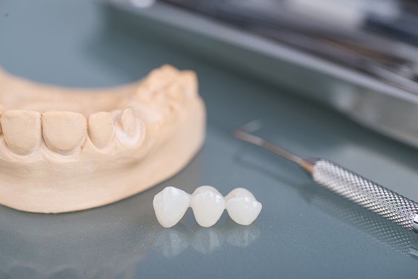 When A Dental Bridge May Be Recommended