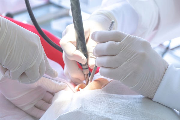 What To Do If You Damage A Dental Filling