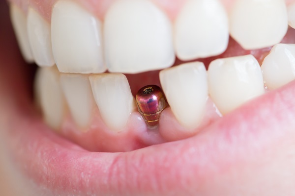 Dental Implants Ann Arbor, MI
