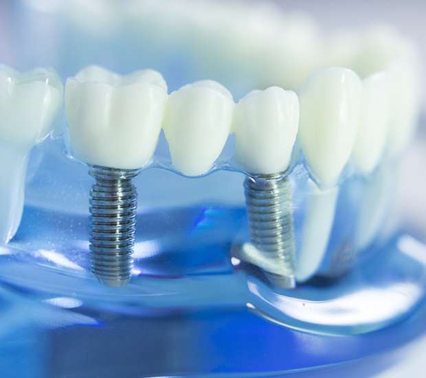 Ann Arbor Dental Implants