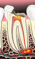 root canal