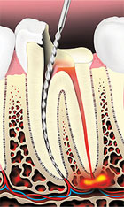 root canal