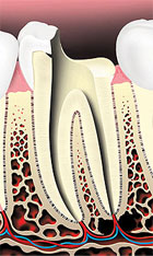 root canal