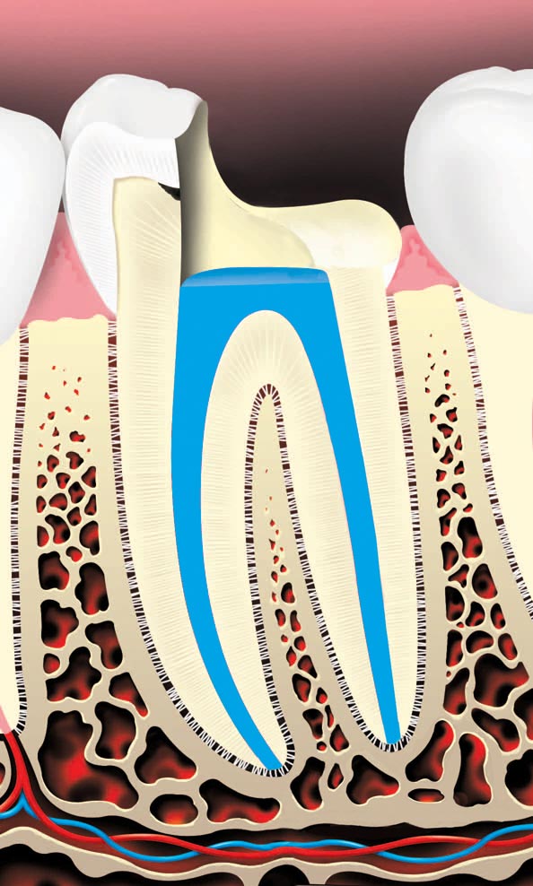 root canal