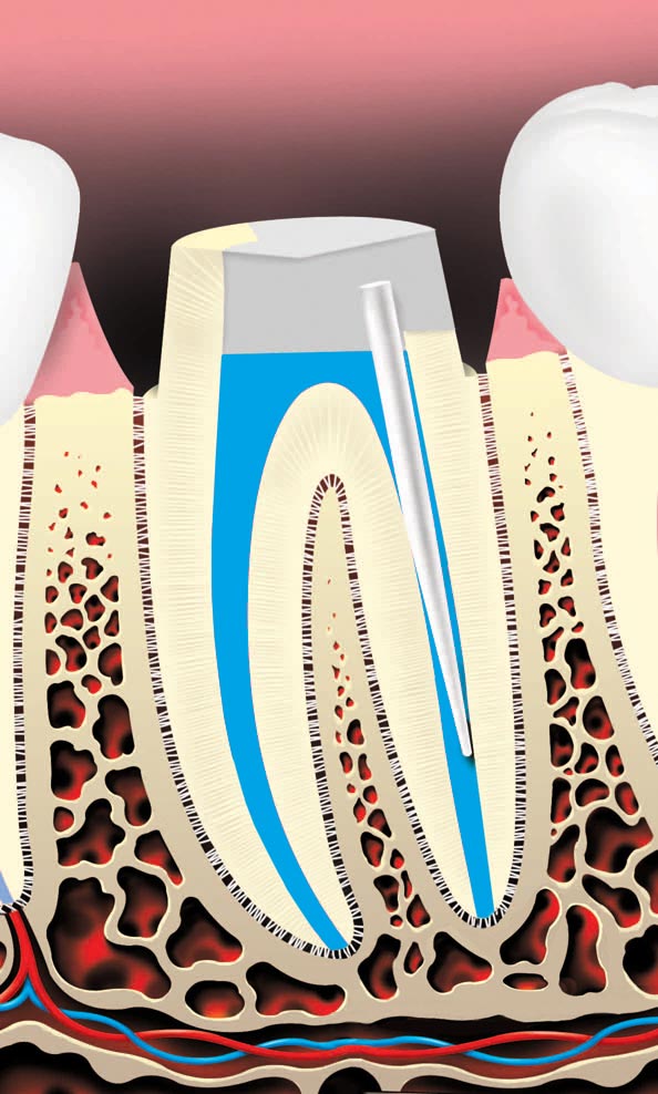 root canal