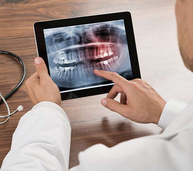 Ann Arbor Types of Dental Root Fractures
